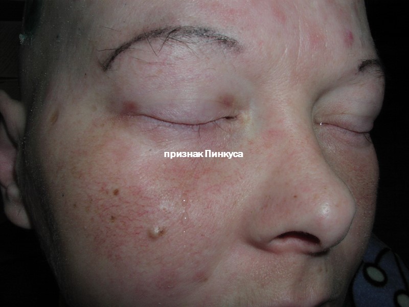 признак Пинкуса